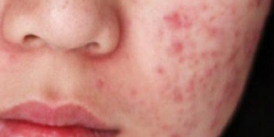 Imagem do grupo de WhatsApp Acabando com ACNES