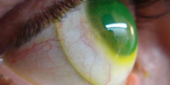 Imagem do grupo de WhatsApp Ceratocone Gaucho 👁️