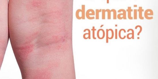 Imagem do grupo de WhatsApp Dermatite  Atopica