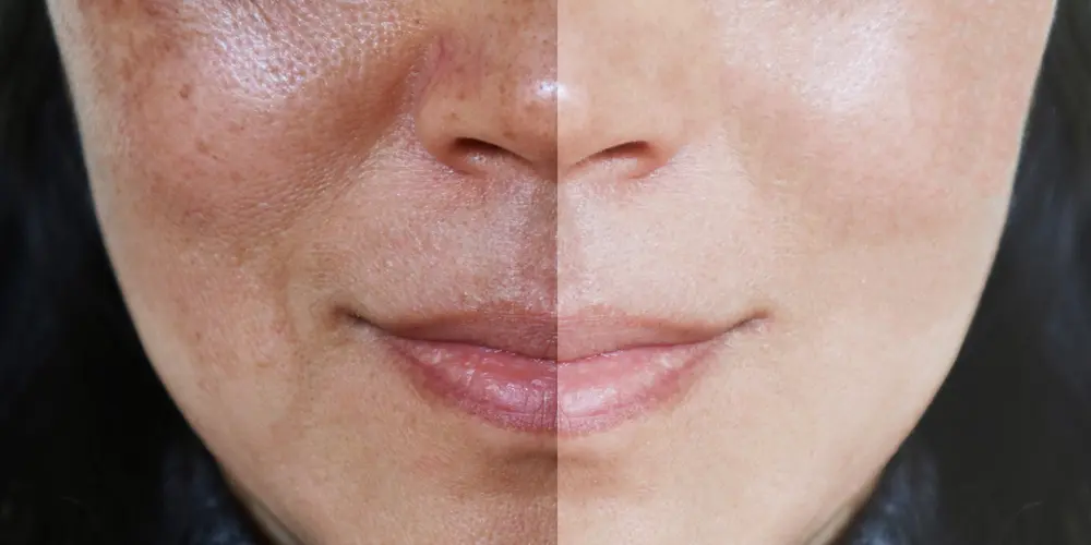 Imagem do grupo de WhatsApp Chega de Melasma